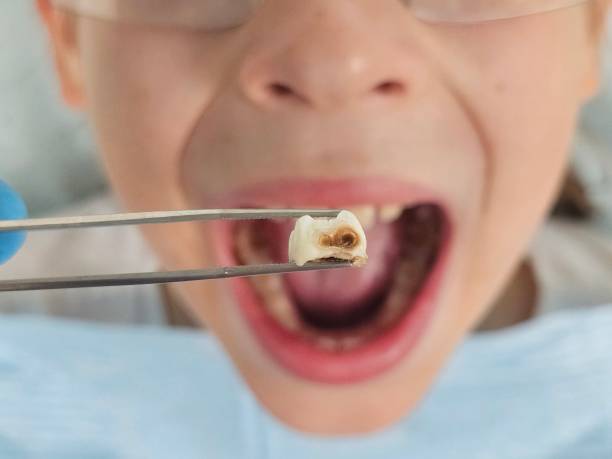 Best Urgent Care for Lost Fillings or Crowns in Prospect, OH